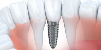 Cirugía oral e implantes